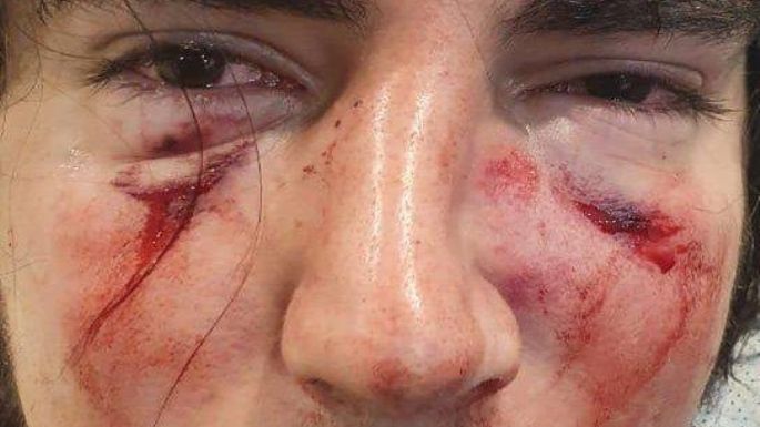 Cuatro rugbiers fueron denunciados por una brutal golpiza a un joven de 18 años