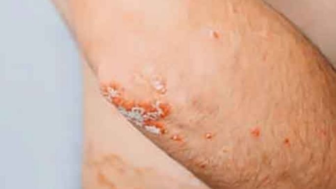 Psoriasis, más que algo de piel