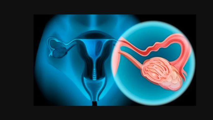 Presentaron nuevo tratamiento para cáncer de ovario en pacientes recién diagnosticadas o con recaída