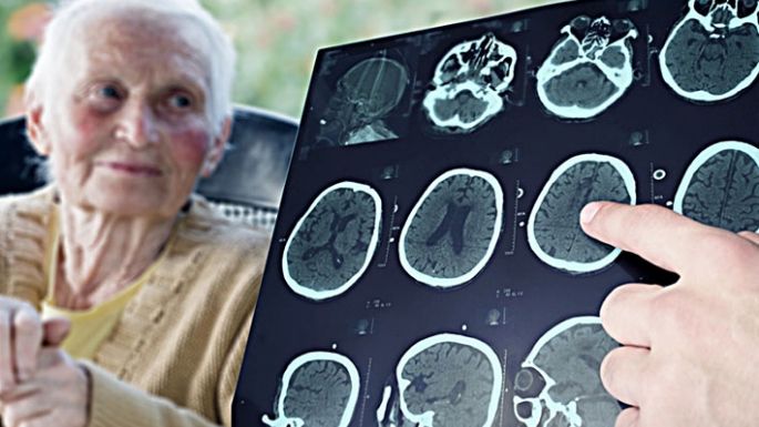 Alzheimer: podrían detectarlo mediante análisis de sangre