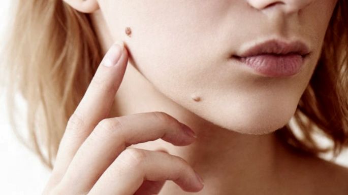 Lanzaron una campaña gratuita de revisión de lunares para prevenir el cáncer de piel