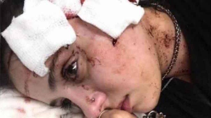 Mutilaron con un vaso de vidrio el rostro de una moza en un bar