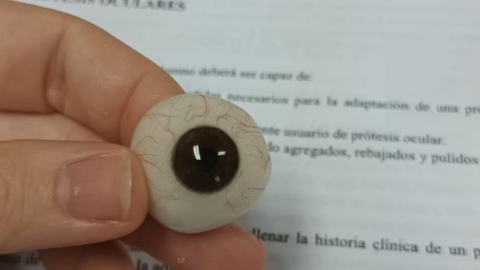 Perdió un ojo y le adaptaron  una nueva prótesis en la UNVM