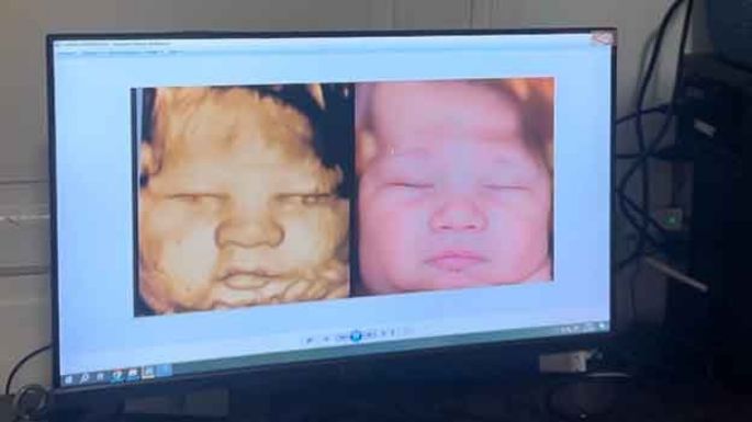 La ecografía 5D y la IA mostraron por anticipado la cara de Mateo