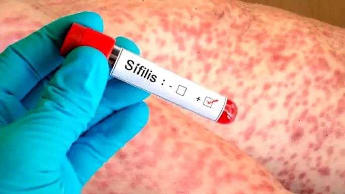 Aumento de casos de sífilis en la provincia