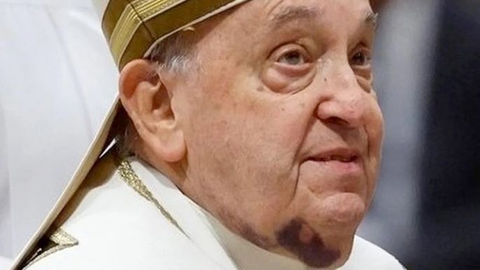 Francisco padece neumonía bilateral