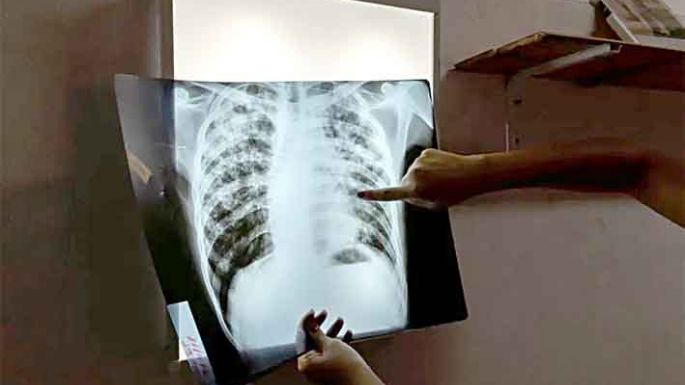 Día Mundial de la Tuberculosis: una enfermedad que crece