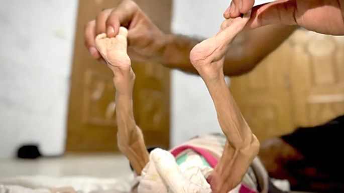 Horror en Gaza: crece el número de bebés que mueren por la hambruna