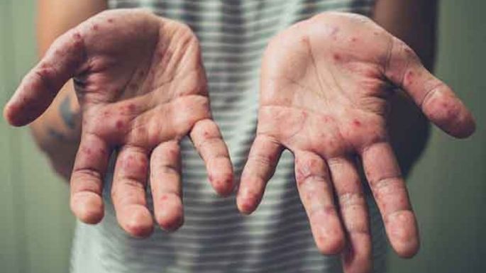 Alertan por los casos de sarampión en América
